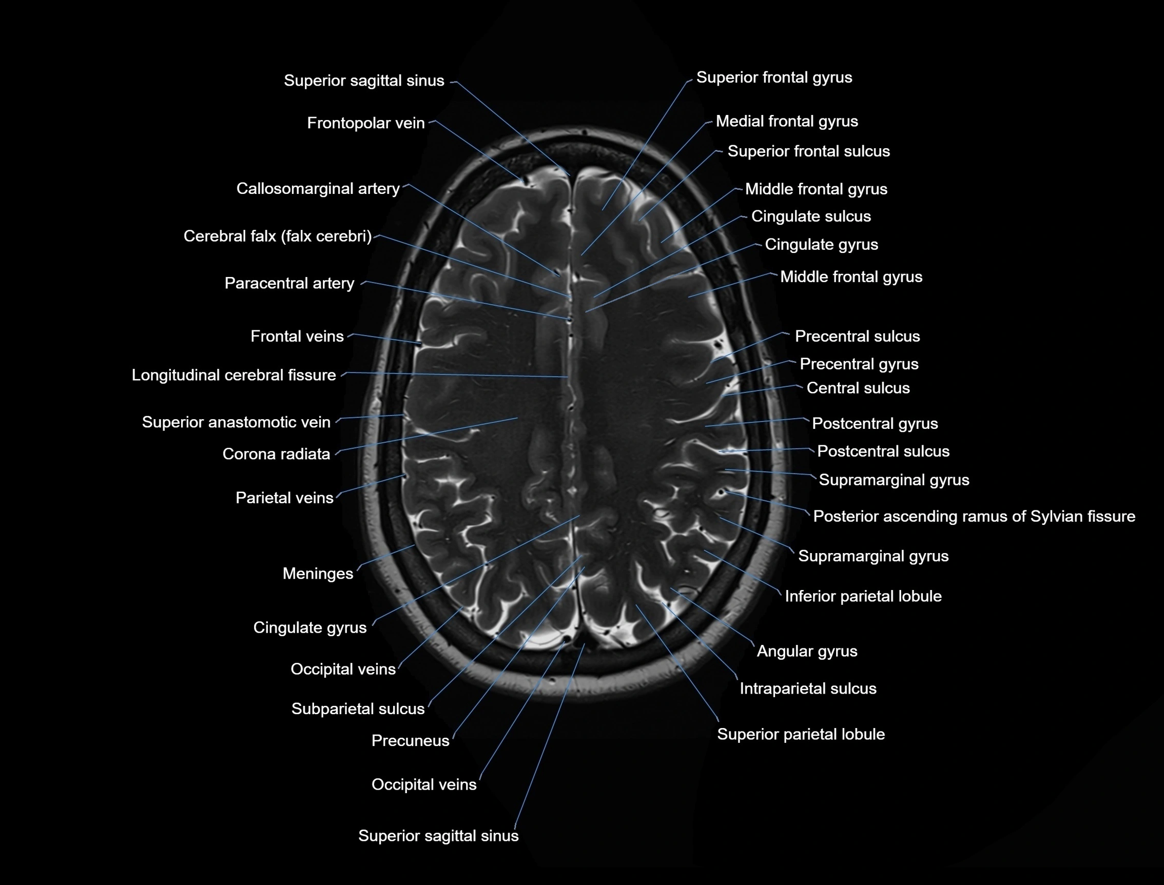 MRI Brain axial cross sectional radiology anatomy 3T image  -img-00001-00042.webp